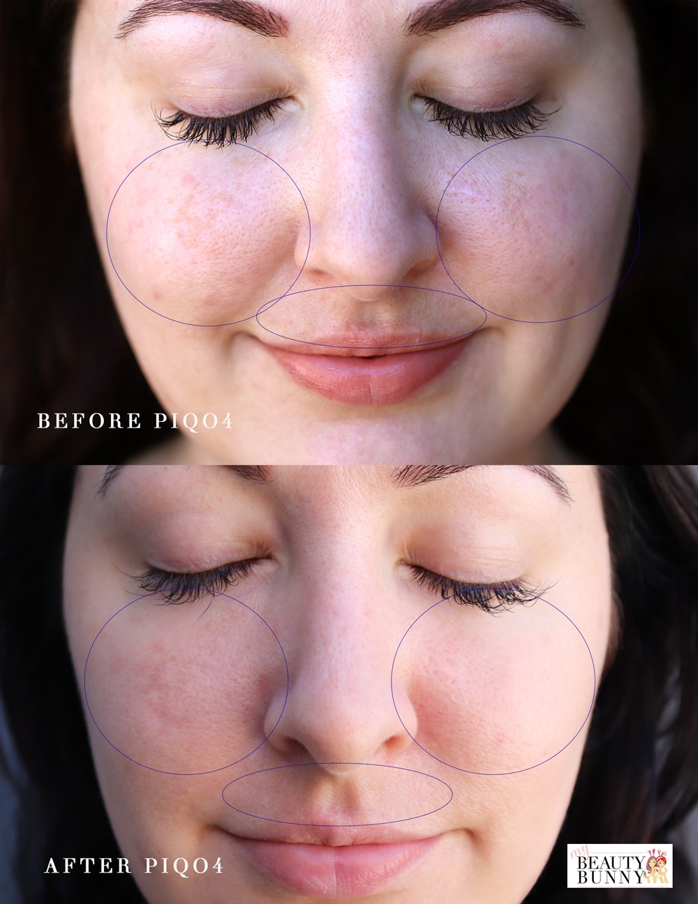 PiQo4 Laser - the Only Melasma Treatment that has Ever Worked for Me! featured by popular Los Angeles cruely free beauty blogger My Beauty Bunny 