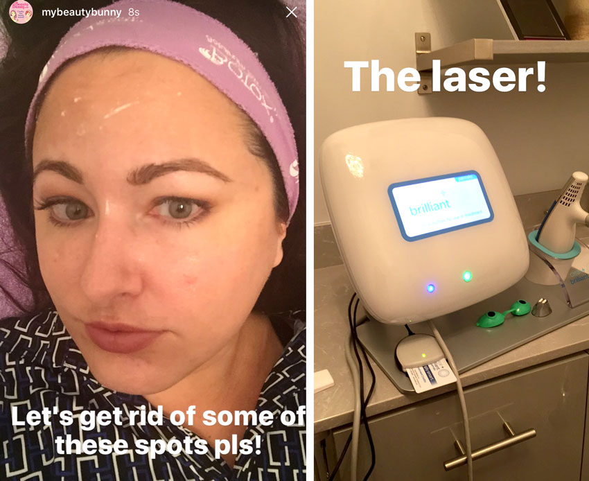 CRMC Clear + Brilliant Laser Treatment Review - Clear and Brilliant Laser Treatment review by popular Los Angeles beauty blogger My Beauty Bunny