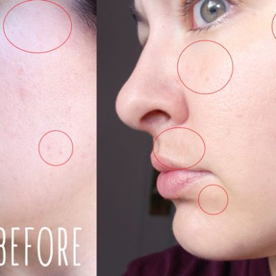 Clear and Brilliant Laser Before and After - Clear and Brilliant Laser Treatment review by popular Los Angeles beauty blogger My Beauty Bunny