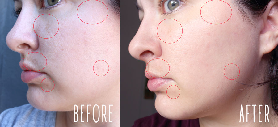 Clear + Brilliant Laser Before and After - Clear and Brilliant Laser Treatment review by popular Los Angeles beauty blogger My Beauty Bunny