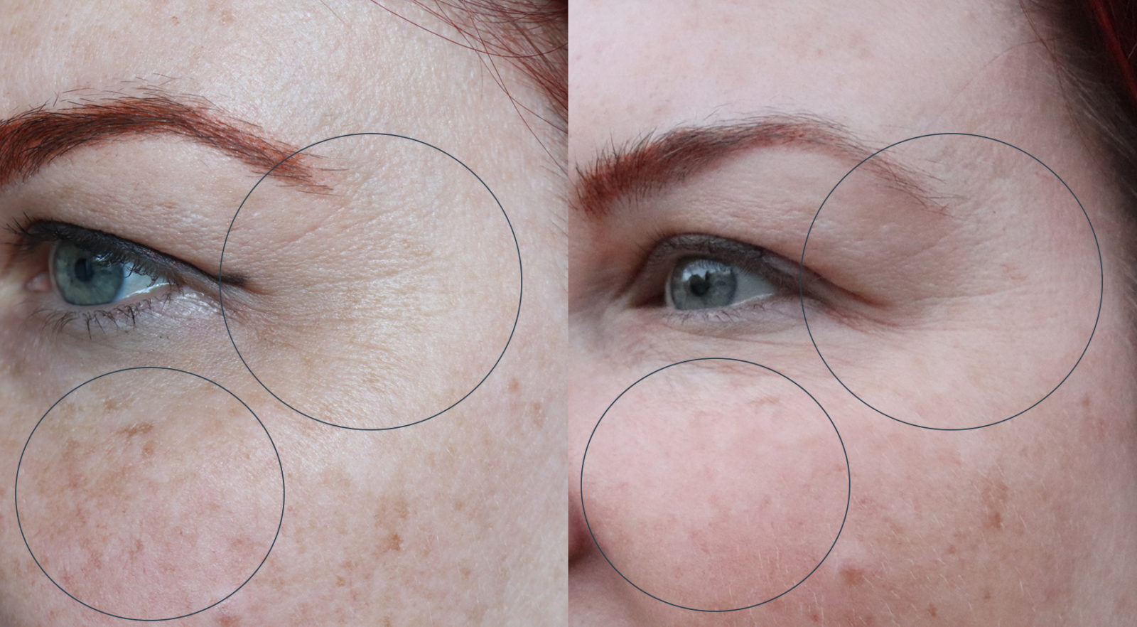 Skin Laundry Ultra Fractional Laser Treatment Review - Before and After