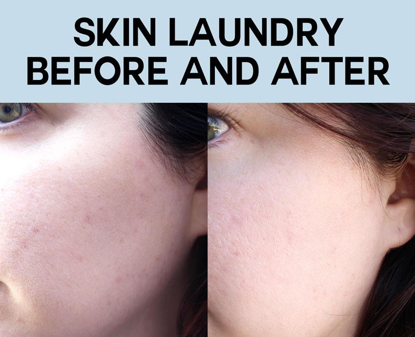 Men and women are flocking to Skin Laundry locations to get super quick, deep-cleaning laser and light facials. These facials help with various skin issues.